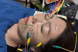 美容鍼パルスの施術中のお顔（鍼に電極をつないだ様子）