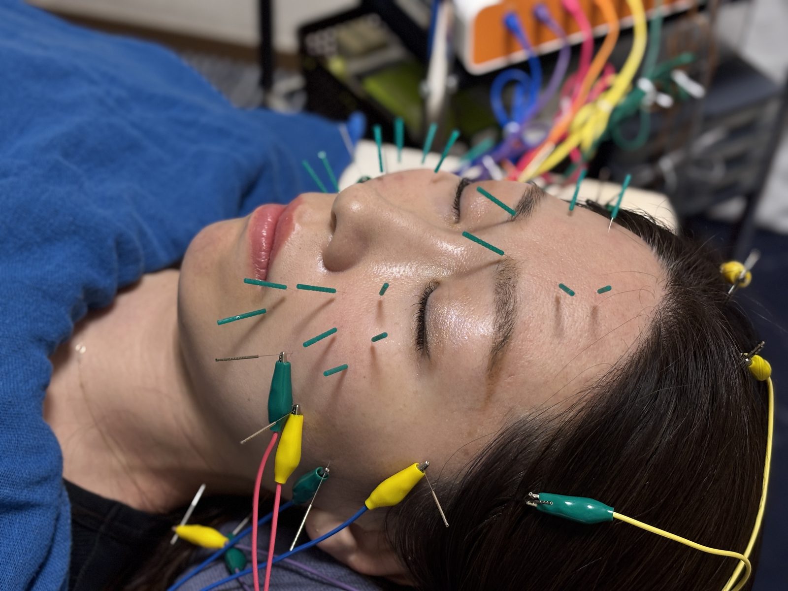 美容鍼パルスの施術中のお顔（鍼に電極をつないだ様子）