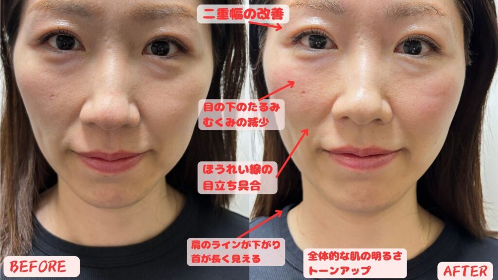 美容鍼パルス施術前後の比較（ご本人掲載許可済み）